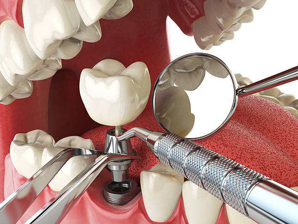 Best Emergency Dentist for Lost Fillings or Crowns in El Dorado Hills, CA