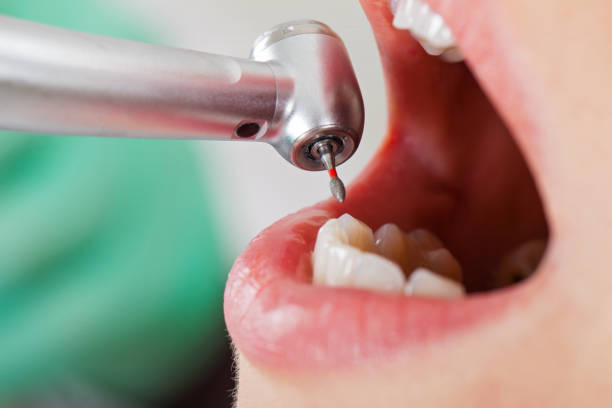 Best Emergency Dentist for Lost Fillings or Crowns in El Dorado Hills, CA